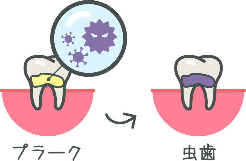 プラークとむし歯 白羽歯科医院
